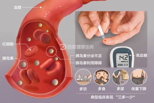 糖尿病(疾病名)