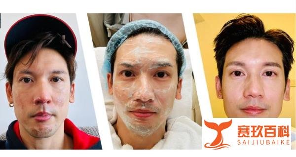 知名男星关智斌面手部二级烧伤！